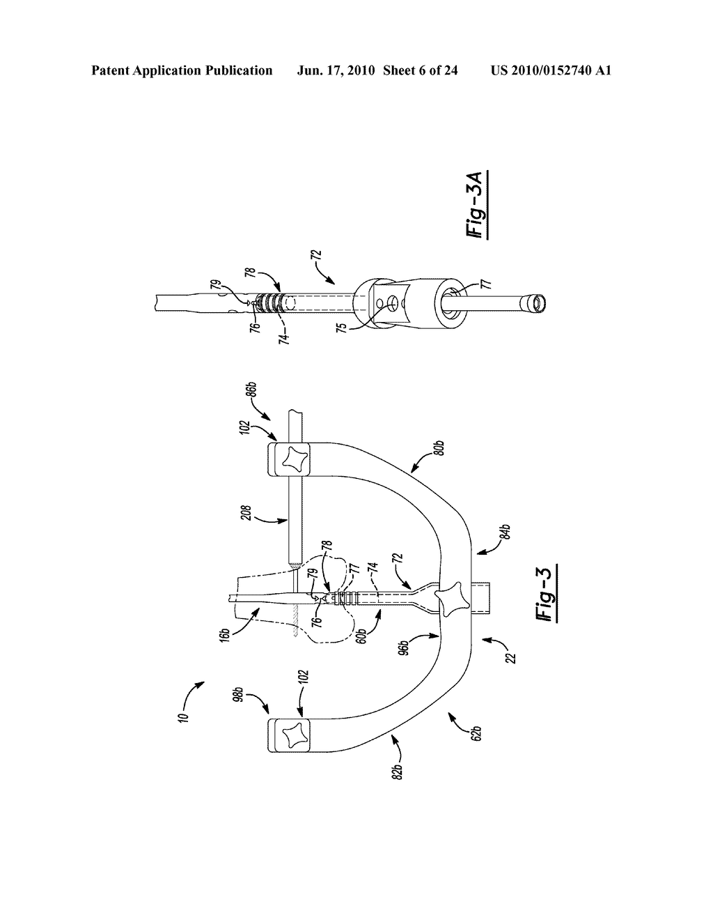 METHOD AND APPARATUS FOR ORTHOPEDIC FIXATION - diagram, schematic, and image 07