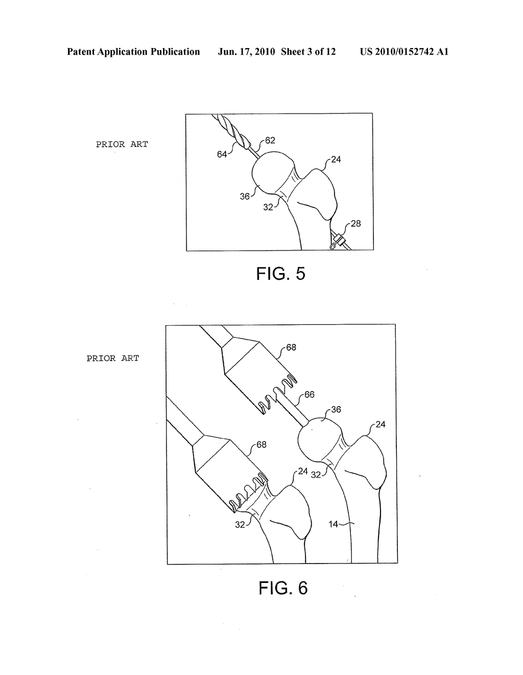 HEAD CENTERING JIG FOR FEMORAL RESURFACING - diagram, schematic, and image 04