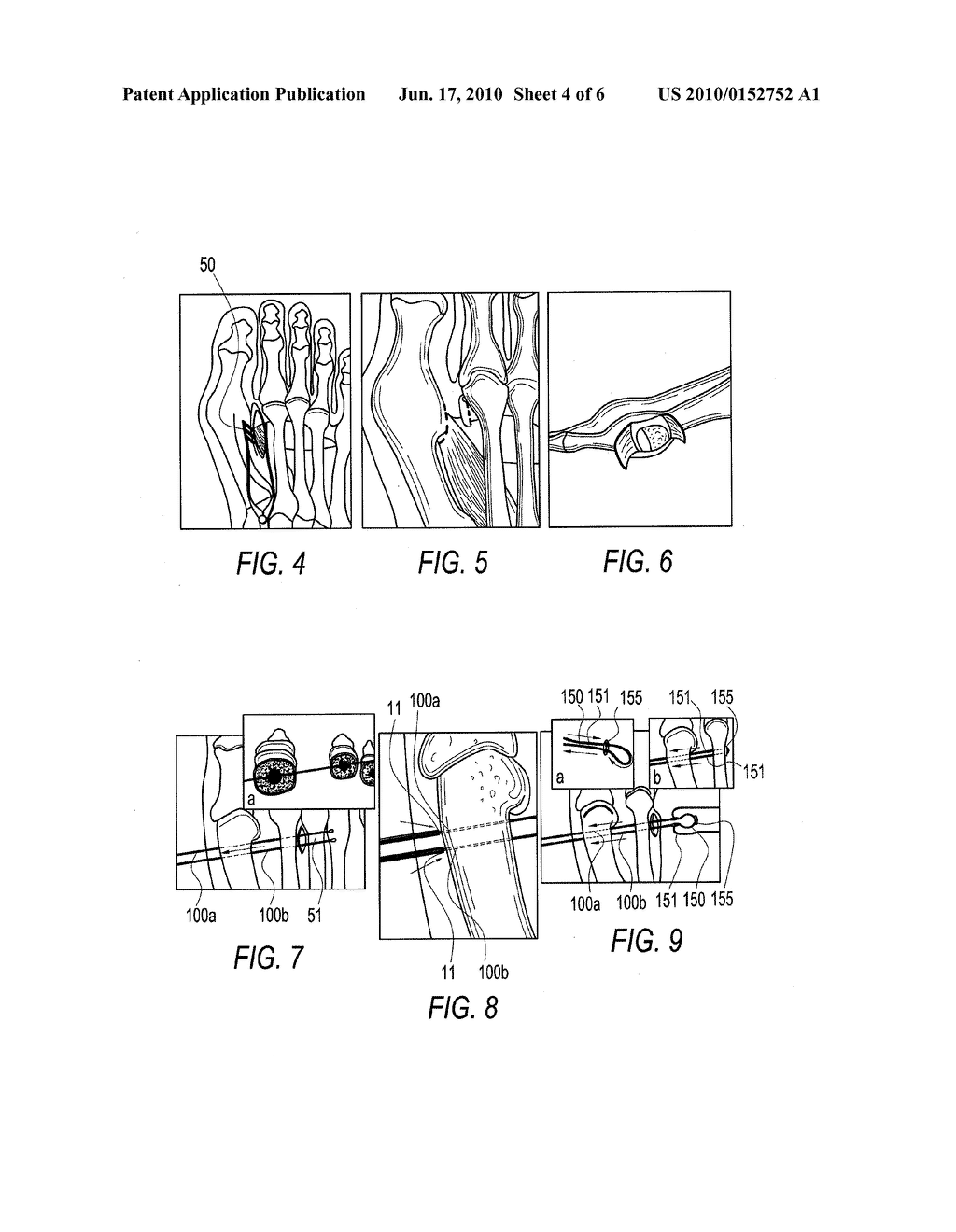 SUTURE PASSING K-WIRE - diagram, schematic, and image 05