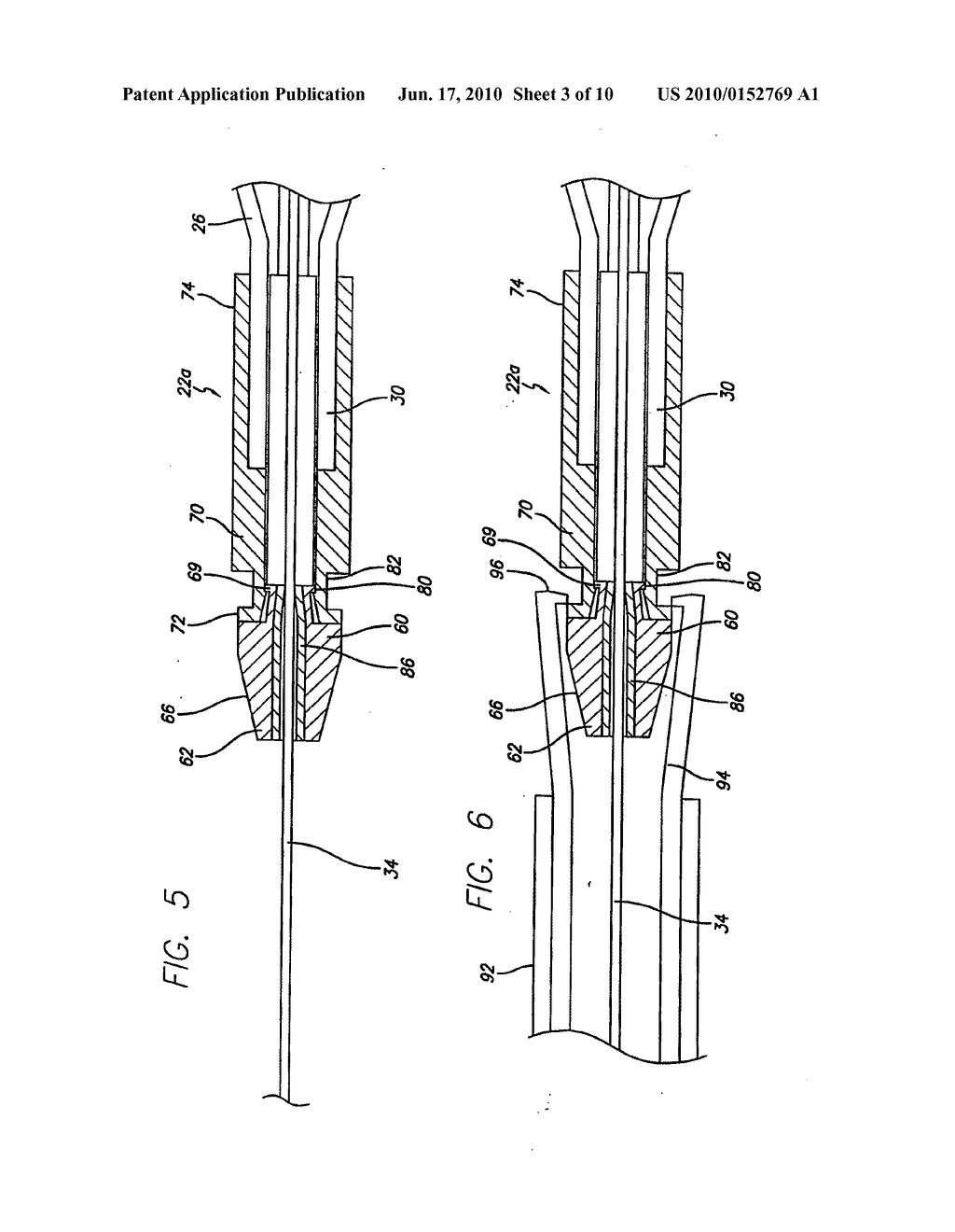 LOCKING COMPONENT FOR AN EMBOLIC FILTER ASSEMBLY - diagram, schematic, and image 04