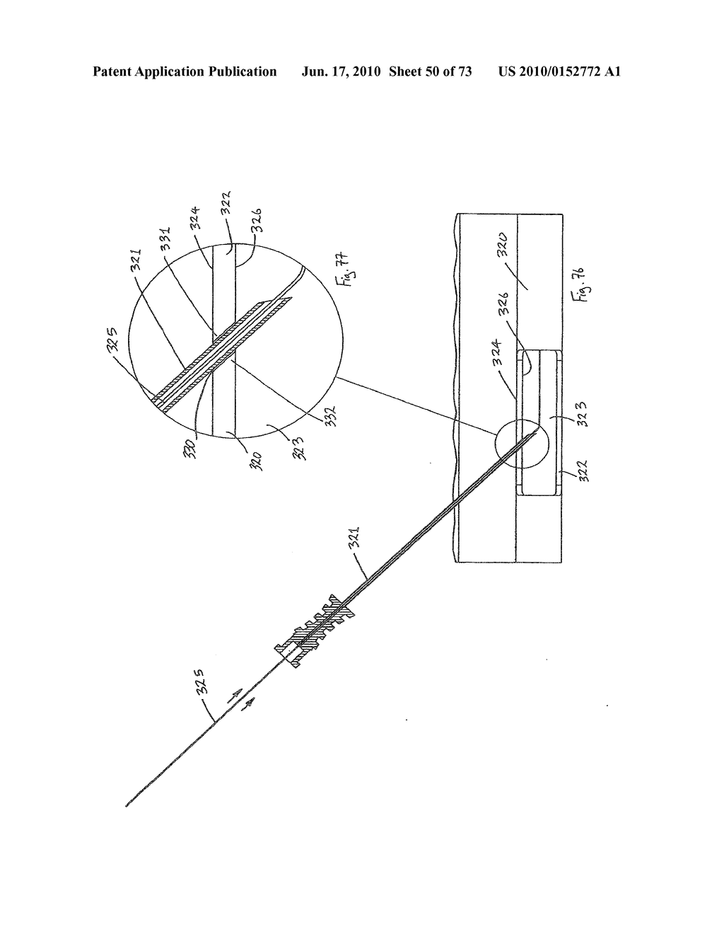 INTERVENTIONAL MEDICAL CLOSURE DEVICE - diagram, schematic, and image 51