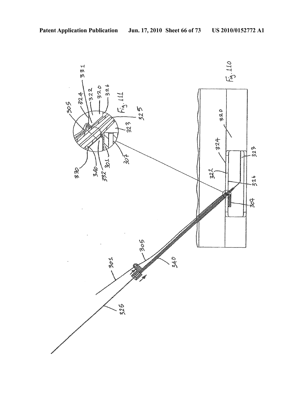 INTERVENTIONAL MEDICAL CLOSURE DEVICE - diagram, schematic, and image 67