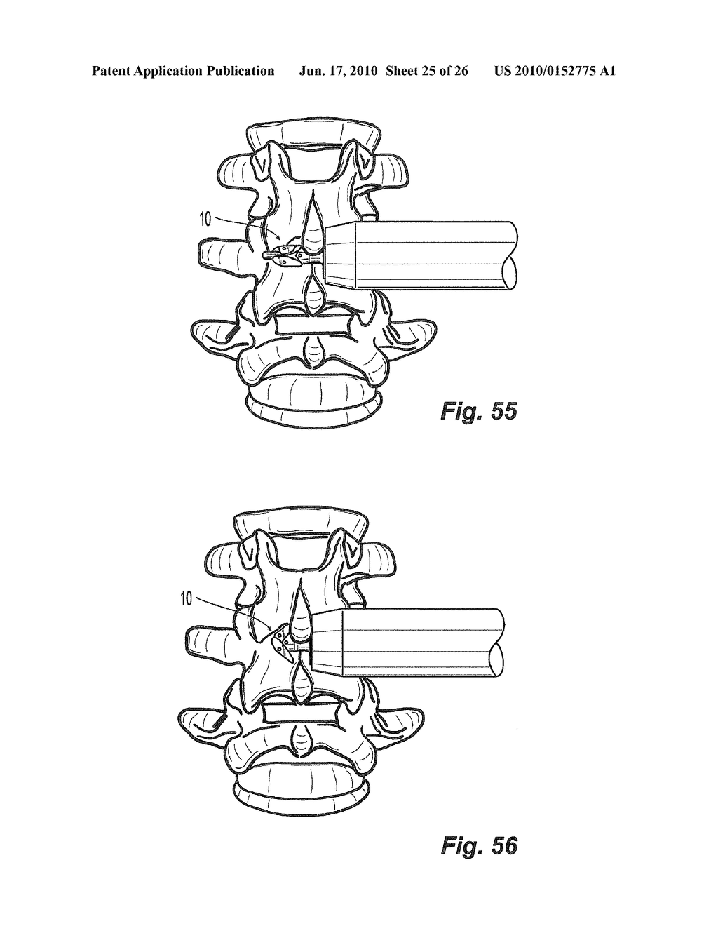 Lateral Spinous Process Spacer With Deployable Wings - diagram, schematic, and image 26