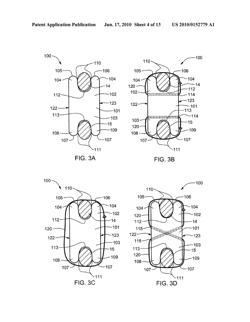 INTER-TRANSVERSE PROCESS SPACER DEVICE AND METHOD FOR USE IN CORRECTING A SPINAL DEFORMITY - diagram, schematic, and image 05