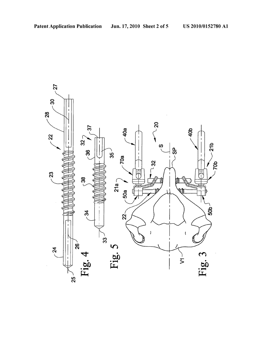 SPINOUS PROCESS ANCHORING SYSTEMS AND METHODS - diagram, schematic, and image 03