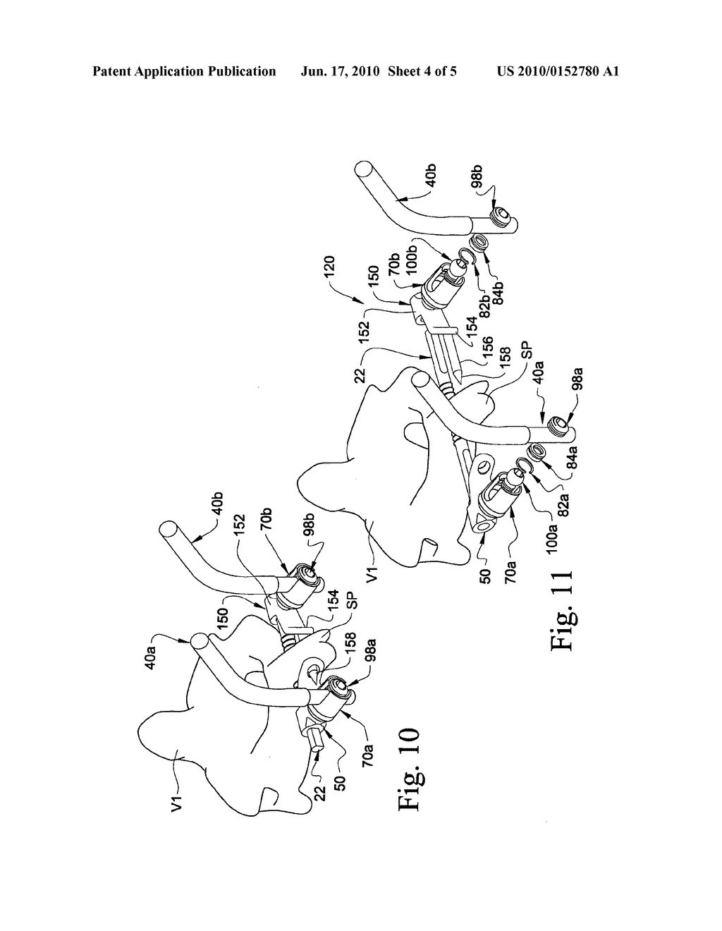 SPINOUS PROCESS ANCHORING SYSTEMS AND METHODS - diagram, schematic, and image 05