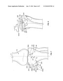 Patient Specific High Tibia Osteotomy diagram and image