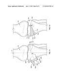 Patient Specific High Tibia Osteotomy diagram and image