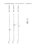 IDENTIFICATION OF DYSYNCHRONY USING INTRACARDIAC ELECTROGRAM DATA diagram and image