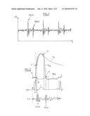 ACTIVE IMPLANTABLE MEDICAL DEVICE HAVING ANTITACHYCARDIA ATRIAL AND ANTIBRADYCARDIA VENTRICULAR PACING diagram and image