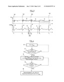 ACTIVE IMPLANTABLE MEDICAL DEVICE HAVING ANTITACHYCARDIA ATRIAL AND ANTIBRADYCARDIA VENTRICULAR PACING diagram and image