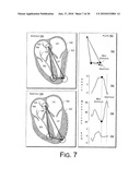 Cardiac Resynchronization Therapy Optimization Using Vector Measurements Obtained from Realtime Electrode Position Tracking diagram and image