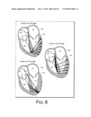 Cardiac Resynchronization Therapy Optimization Using Vector Measurements Obtained from Realtime Electrode Position Tracking diagram and image