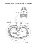 Systems and methods to place one or more leads in tissue to electrically stimulate nerves of passage to treat pain diagram and image