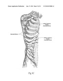 Systems and methods to place one or more leads in tissue to electrically stimulate nerves of passage to treat pain diagram and image