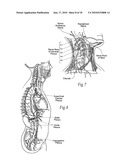 Systems and methods to place one or more leads in tissue to electrically stimulate nerves of passage to treat pain diagram and image