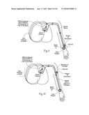 Systems and methods to place one or more leads in tissue to electrically stimulate nerves of passage to treat pain diagram and image