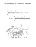 Systems and methods to place one or more leads in tissue to electrically stimulate nerves of passage to treat pain diagram and image