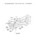 Systems and methods to place one or more leads in tissue to electrically stimulate nerves of passage to treat pain diagram and image