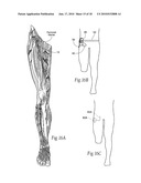 Systems and methods to place one or more leads in tissue to electrically stimulate nerves of passage to treat pain diagram and image