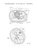 Systems and methods to place one or more leads in tissue to electrically stimulate nerves of passage to treat pain diagram and image