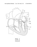 Implantable Valvular Prosthesis diagram and image