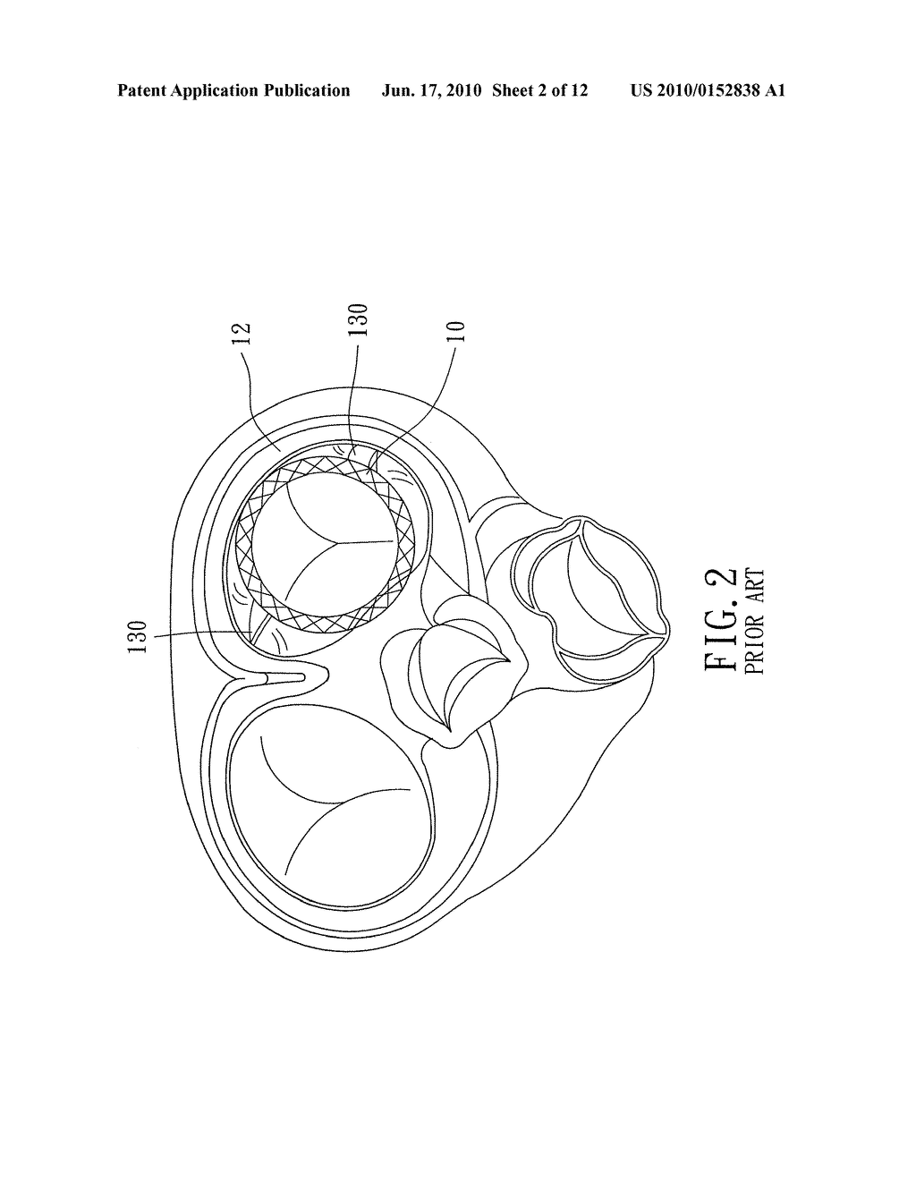 Implantable Valvular Prosthesis - diagram, schematic, and image 03