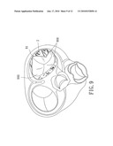 Implantable Valvular Prosthesis diagram and image