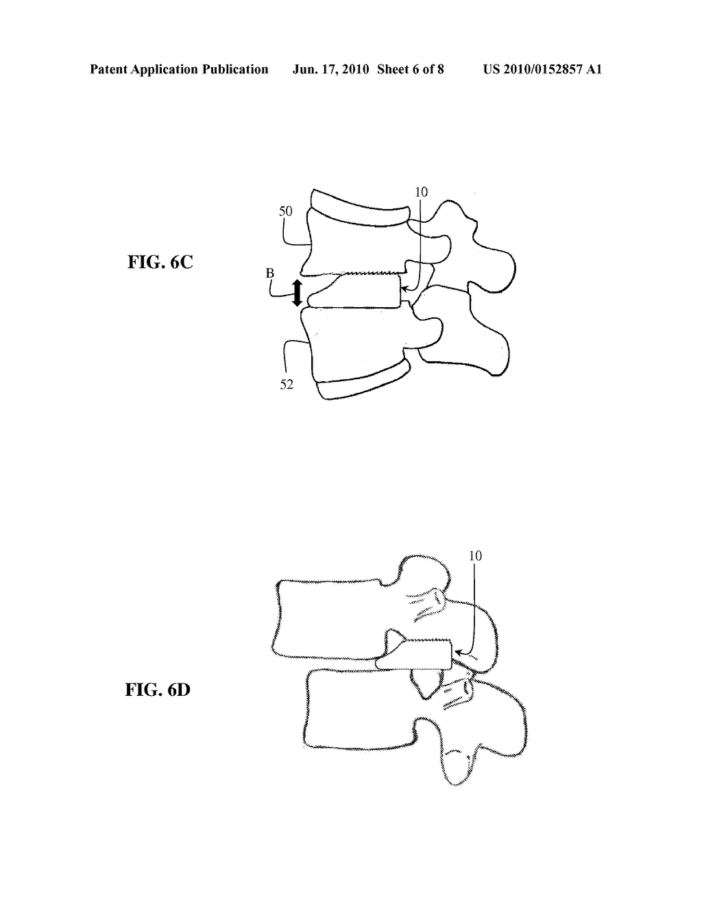 Asymmetric Disc Distracting Cage - diagram, schematic, and image 07