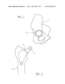  ASSEMBLY FOR USE IN A HIP JOINT REPLACEMENT PROCEDURE diagram and image