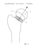  ASSEMBLY FOR USE IN A HIP JOINT REPLACEMENT PROCEDURE diagram and image