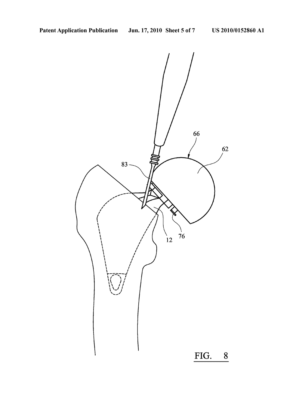  ASSEMBLY FOR USE IN A HIP JOINT REPLACEMENT PROCEDURE - diagram, schematic, and image 06