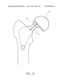  ASSEMBLY FOR USE IN A HIP JOINT REPLACEMENT PROCEDURE diagram and image