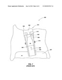 METHODS OF ENHANCING RETENTION FORCES BETWEEN INTERFERING PARTS, AND STRUCTURES FORMED BY SUCH METHODS diagram and image