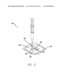 METHODS AND SYSTEMS FOR STORING MEDICAL IMPLANTS UNDER SUSTAINED VACUUM diagram and image