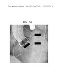 AUTOMATIC STABILIZATION OF AN IMAGE STREAM OF A MOVING ORGAN diagram and image