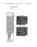 IMPLANT PROVIDED WITH ATTACHMENT AND HOLE-INSERT PARTS, AND A METHOD FOR PRODUCING SUCH AN IMPLANT diagram and image