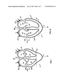 CARDIAC SUPPORT DEVICE WITH DIFFERENTIAL COMPLIANCE diagram and image