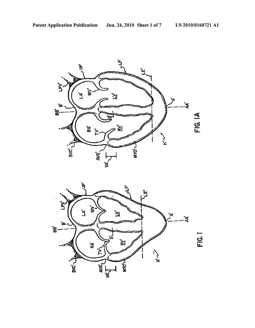 CARDIAC SUPPORT DEVICE WITH DIFFERENTIAL COMPLIANCE - diagram, schematic, and image 02