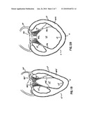 CARDIAC SUPPORT DEVICE WITH DIFFERENTIAL COMPLIANCE diagram and image