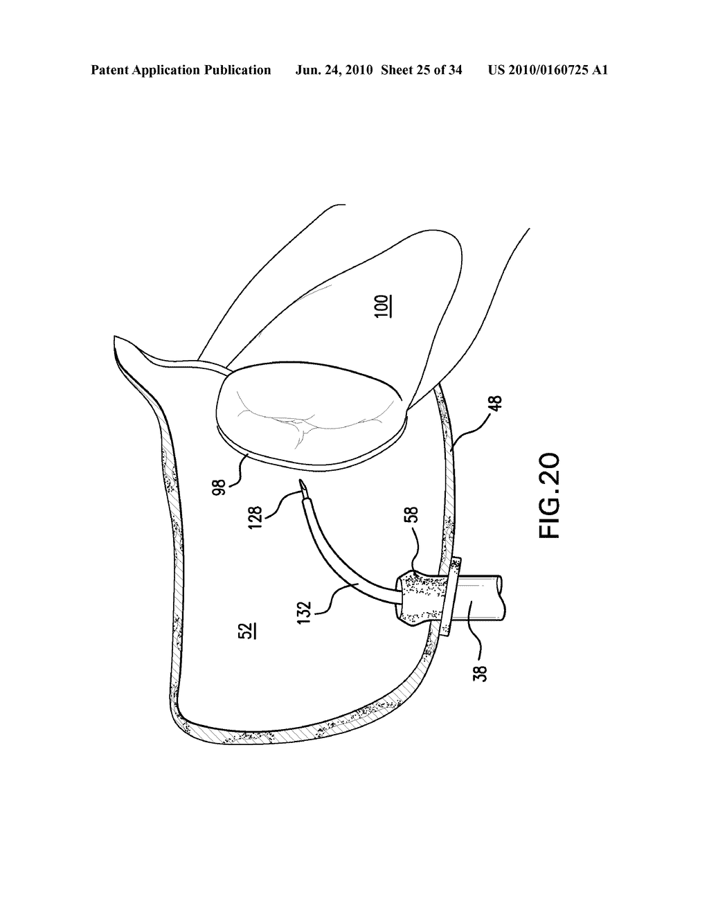 Methods and Devices for Endoscopic Access to the Heart - diagram, schematic, and image 26