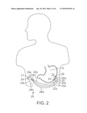 Detection of Food or Drink Consumption In Order to Control Therapy or Provide Diagnostics diagram and image