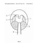 PHOTOTHERMAL TREATMENT OF SOFT TISSUES diagram and image