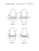 Joint Arthroplasty Devices and Surgical Tools diagram and image