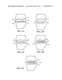 Joint Arthroplasty Devices and Surgical Tools diagram and image