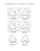 Joint Arthroplasty Devices and Surgical Tools diagram and image