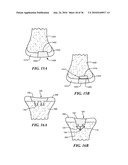 Joint Arthroplasty Devices and Surgical Tools diagram and image