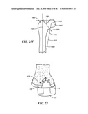 Joint Arthroplasty Devices and Surgical Tools diagram and image