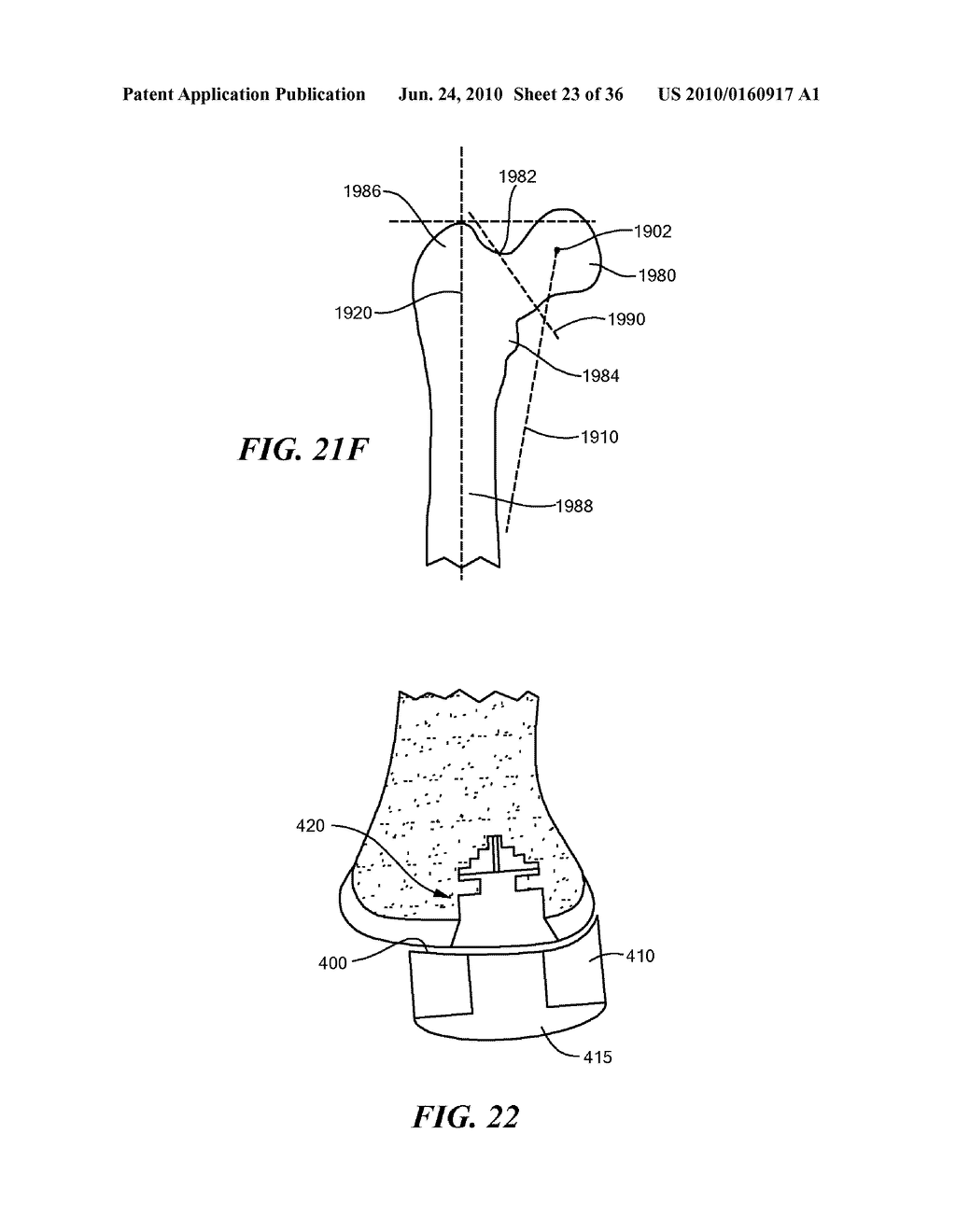 Joint Arthroplasty Devices and Surgical Tools - diagram, schematic, and image 24