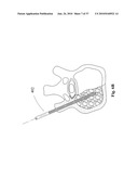 TWO-PART BONE CEMENT COMPOSITE CONTAINING PARTICLES IN A NON-UNIFORM SPATIAL DISTRIBUTION AND DEVICES FOR IMPLEMENTATION diagram and image